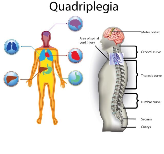 Quadriplegia