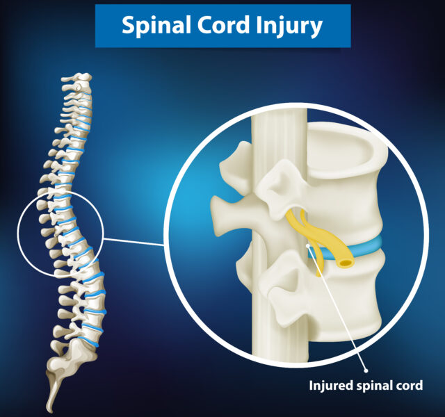 Diagram showing spinal cord injury illustration