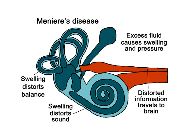 Ménière’s Syndrome
