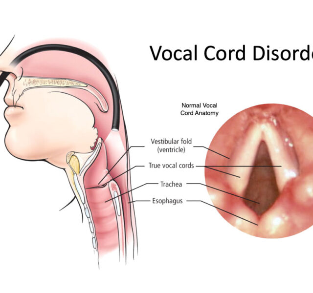 Vocal Cord Paralysis
