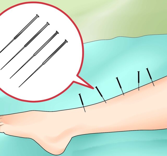 Restless Legs Syndrome