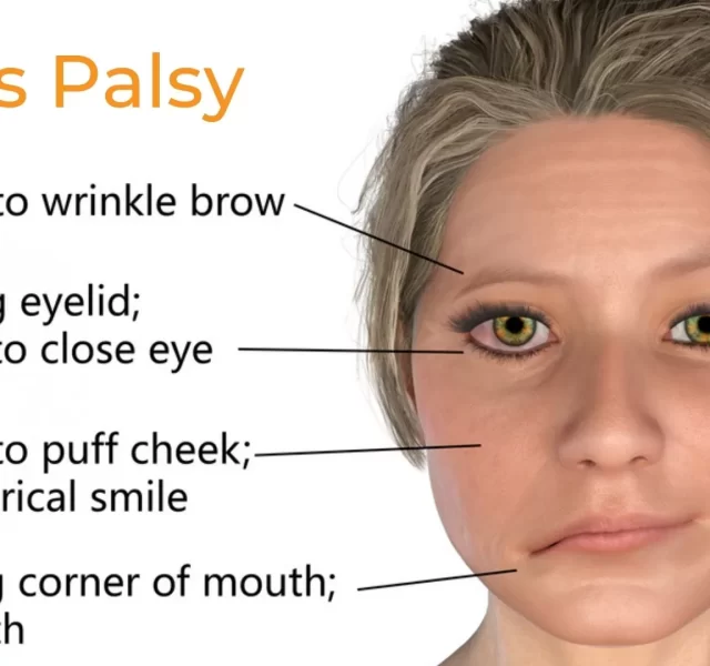 Bell’s Palsy