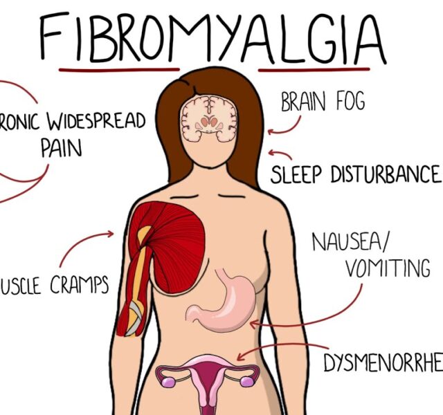 Fibromyalgia