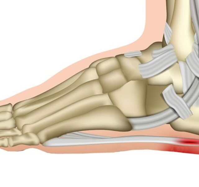 Plantar Fasciitis