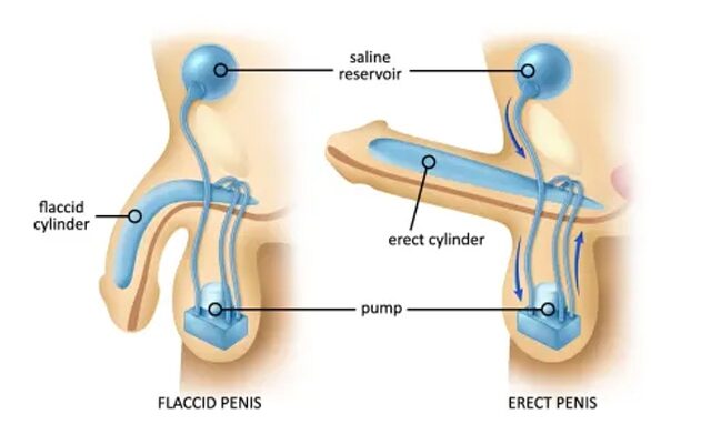 Impotence or Erectile Dysfunction