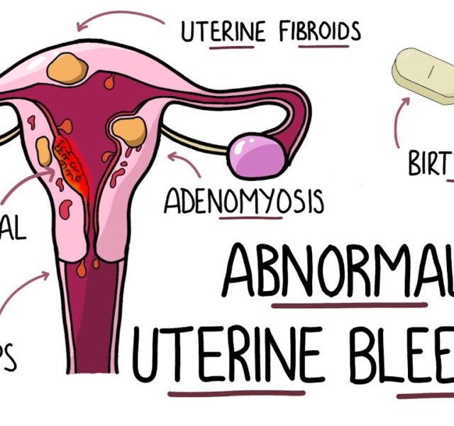Uterine Bleeding